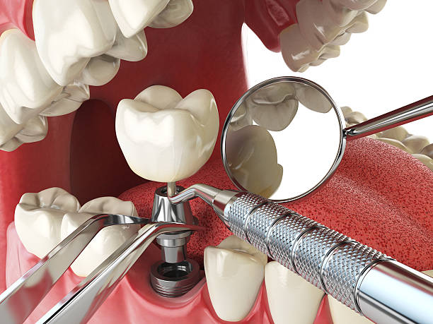 Best Emergency Wisdom Teeth Removal in Abilene, TX